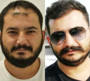 best hair transplant in turkey