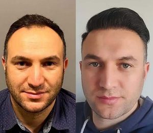 cost of hair transplant in turkey