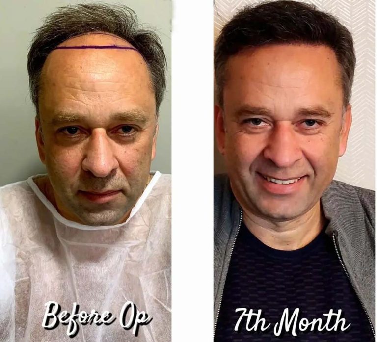 hair transplant clinics in turkey