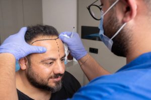 hair transplant turkey