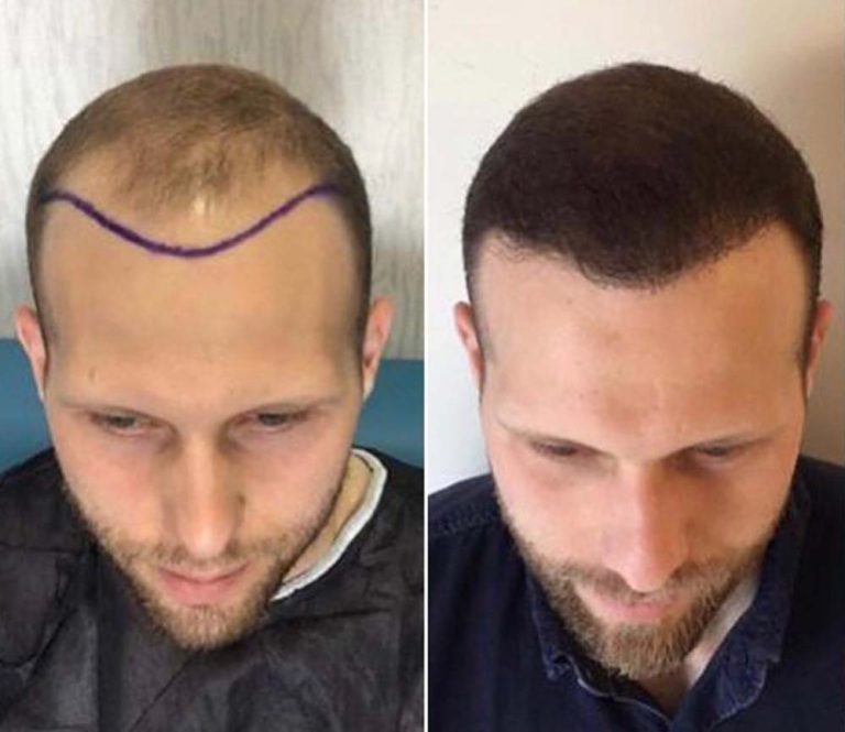 hair transplant turkey payment plan