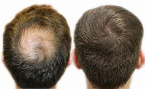 top hair transplant surgeons turkey