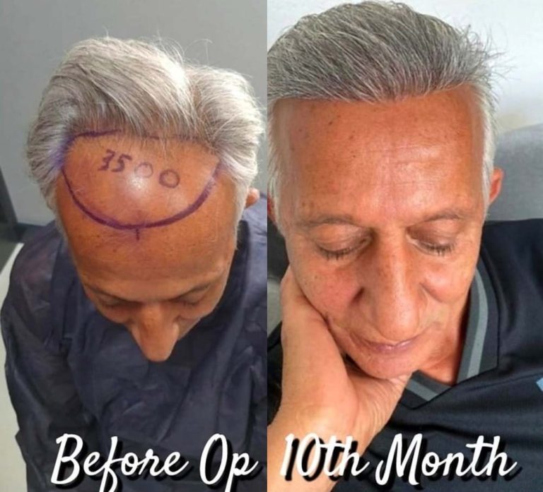 turkey hair restoration surgery