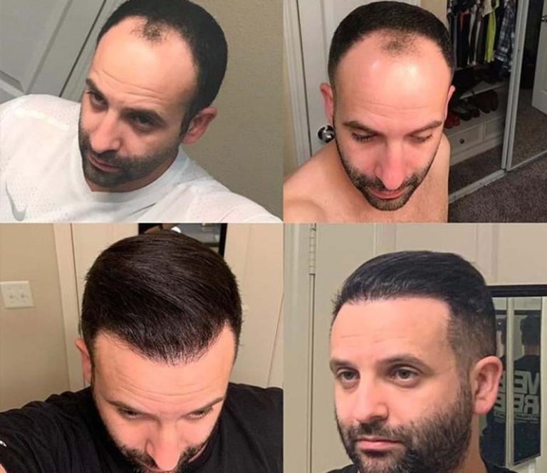 turkey hair transplant before and after