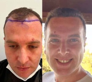 turkey hair transplant cost