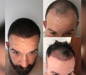 what to expect after hair transplant in turkey